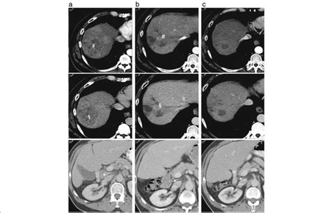 Case 1 Response To Sorafenib A Triple Phase Ct Of The Liver