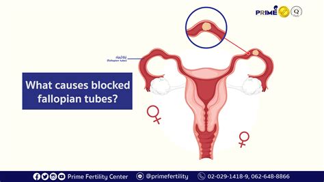 What Causes Blocked Fallopian Tubes Prime Fertility Center