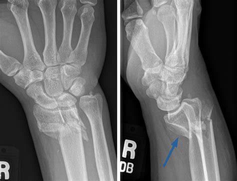 Smith Fracture
