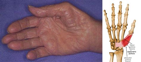 Physical Exam Of The Hand Hand Orthobullets