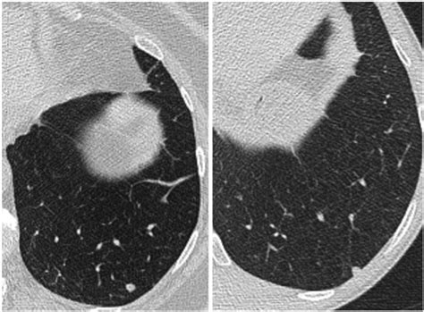 Axial Ct Images Of Two Small Left Lower Lobe Solid Nodules These