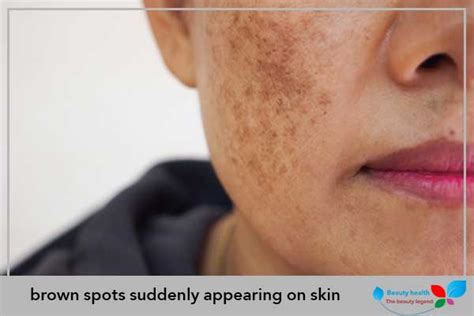 Brown Spots Suddenly Appearing On Skin Treatment Methods