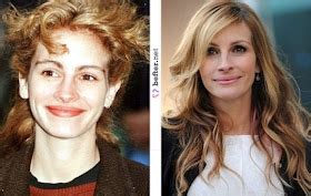 Star Plastic Surgery Before And After Julia Roberts Nose Job Plastic