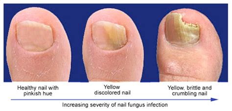 Is It A Toenail Fungal Infection — Pioneer Podiatry