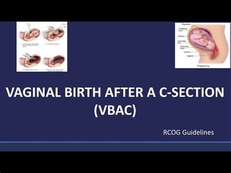 Vaginal Birth After Cesarean Vbac Rcog Guideline Youtube