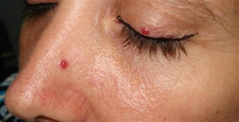 This 50 Facts About Cherry Angioma What Are Cherry Angiomas And Its
