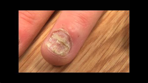 Fungal Nail Infection Youtube