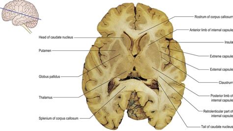 Webmd's brain anatomy page provides a detailed diagram and definition of the brain including its function, parts, and conditions that affect it. Cerebral hemisphere and cerebral cortex | Neupsy Key