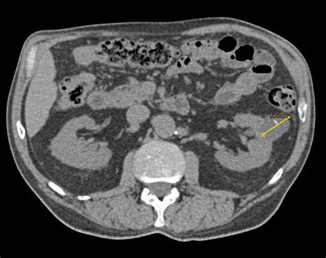Bosniak 2 Cyst Left Kidney Genitourinary Case Studies Ctisus Ct