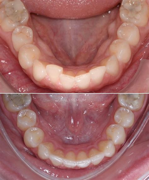 Dentes Alinhados Novamente Com Alinhadores Invisíveis Clínica Oral Premium