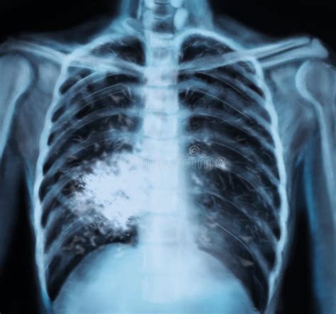 X Ray Of Patient With Lung Cancer Stock Photo Image Of Radiology