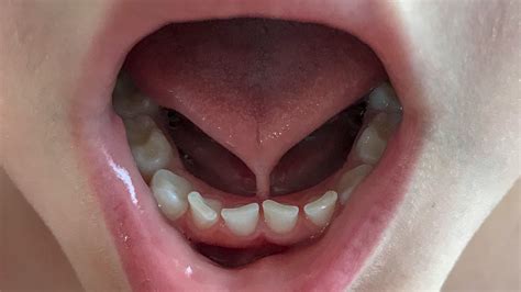 Frenulum In The Mouth My Best Dentists Journal Mybestdentists