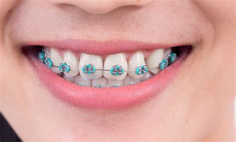 Is Royal Blue The Right Color For Your Braces Health And Fitness