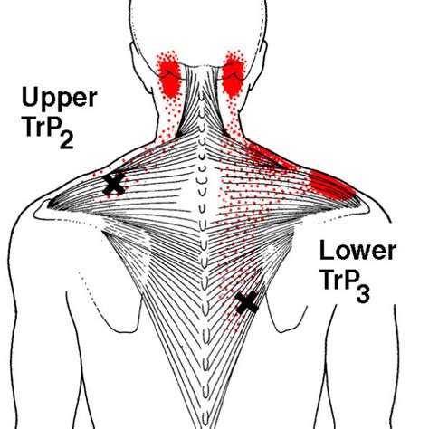 Referred Pain Patterns Red From The Upper And Middle Trapezius Muscle