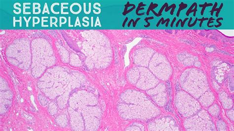 Sebaceous Hyperplasia Dermpath In 5 Minutes Dermatology Pathology