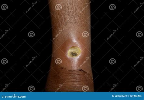 Diabetic Ulcer In Leg Of Asian Patient Stock Photo Image Of Diabetes