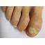 Fungal Nails / Ongles Fongiques  Bruyere Foot Specialists