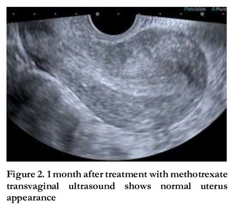 Transvaginal Ultrasound Shows A Gestational Sac At The Site Of The Download Scientific Diagram