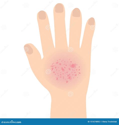 Eczema Affected A Hand Dermatology Skin Disease Concept Stock Vector