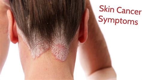 Identify Skin Cancer Symptoms At Very First Stage