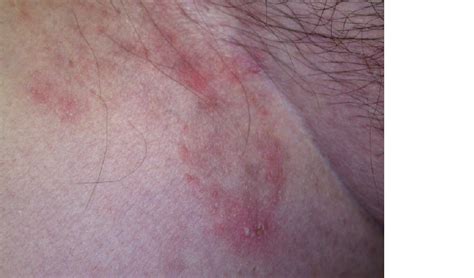 Racgp Superficial Fungal Infections