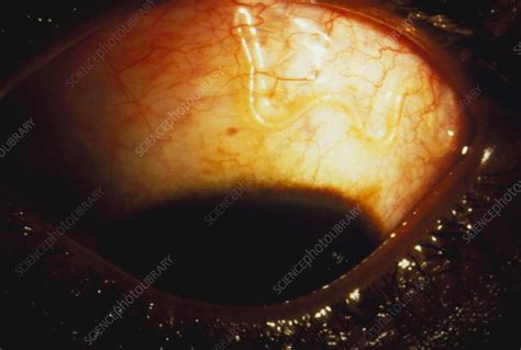 Eye Closeup With Loa Loa Worm Parasite Stock Image M2000093 Science Photo Library