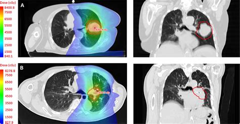 Stereotactic Ablative Radiotherapy Sabr For Early Stage Central Lung
