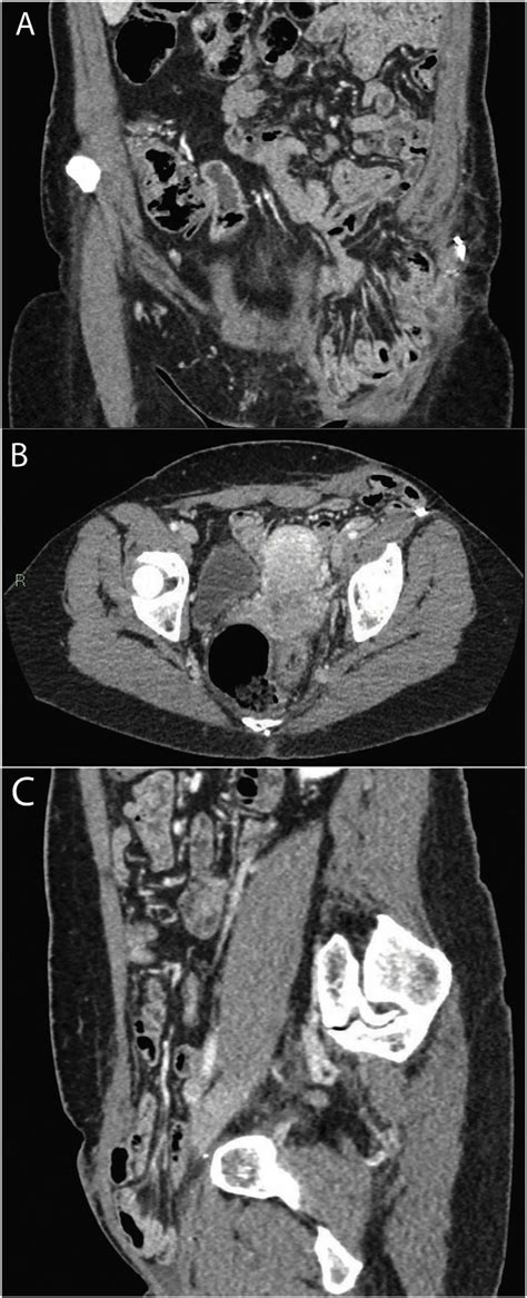 Ct Scan Demonstrating A Large Incisional Inguinal Hernia With
