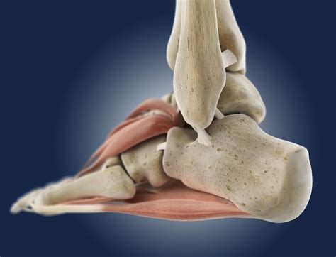 Calcaneus Fracture A Broken Heel Bone