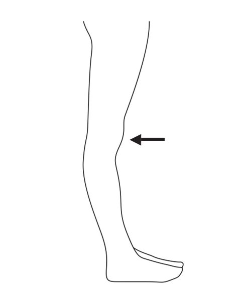 Hyperextended Knees Observation Sensokinetic