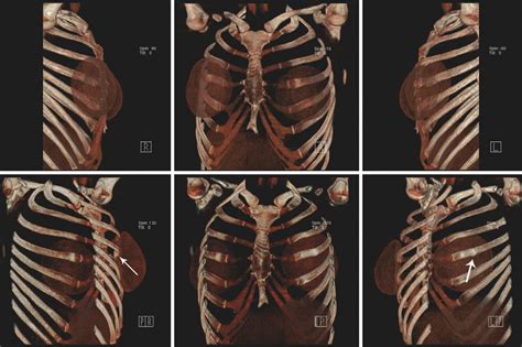 3d Surface Shaded Display From Thoracic Ct Data After The Positioning
