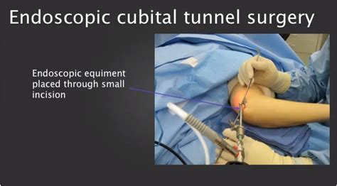 Cubital Tunnel Syndrome Surgery Preparation Procedure