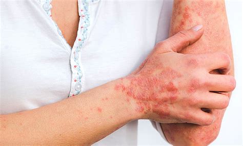 Psoriasis Treatment Symptoms Causes Skin Care Dean
