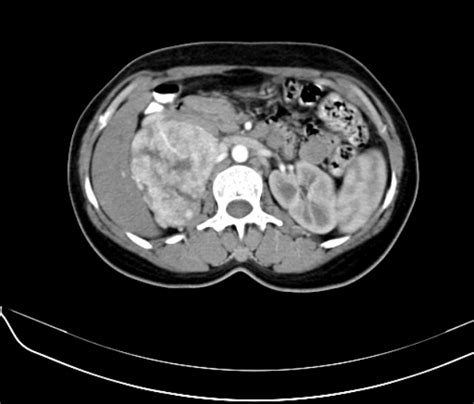 Pheochromocytoma Image