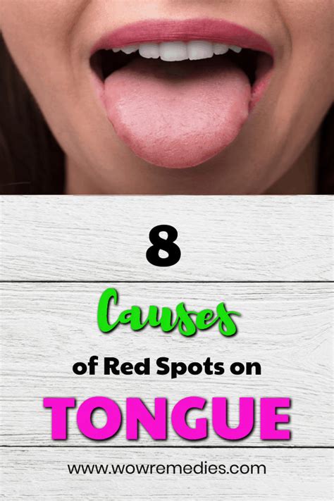 Blood Spots On Tongue