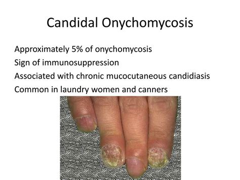 Ppt Candidal Onychomycosis Powerpoint Presentation Free Download