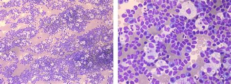 Ascitic Fluid Cytology Showing Lymphocytic Predominant Cells With Foamy