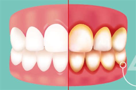 Why You Should Be Cautius About Gingivitis Algodones Dentists Guide