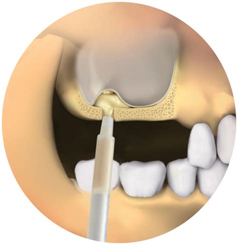 Patient Sinus Liftsbone Grafts Southern Implants