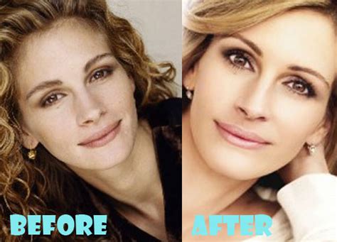Julia Roberts Plastic Surgery Before And After Pictures Lovely Surgery Celebrity Before And