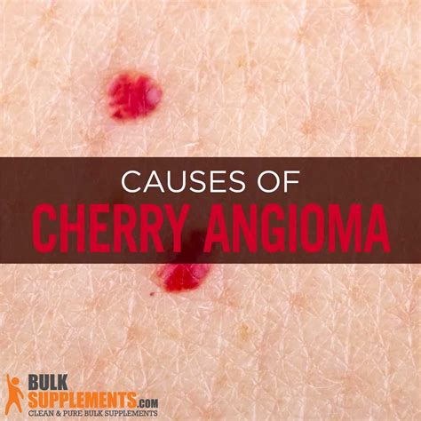 Cherry Angioma Characteristics Causes And Treatment By James Denlinger