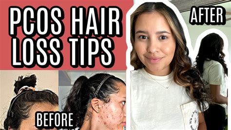 PCOS Hair Loss Products Tips For Regrowth YouTube