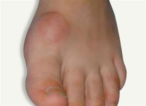 hallux limitus davenport house clinic