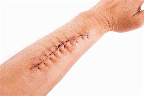 Correção de ferida cirúrgica com grampo no braço isolado no fundo