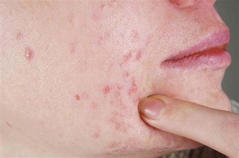 Acne Papule Vs Pustule Whats The Difference Lifestyle
