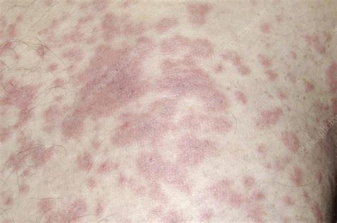 Rash Caused By Tonsillitis Stock Image M2700353 Science Photo