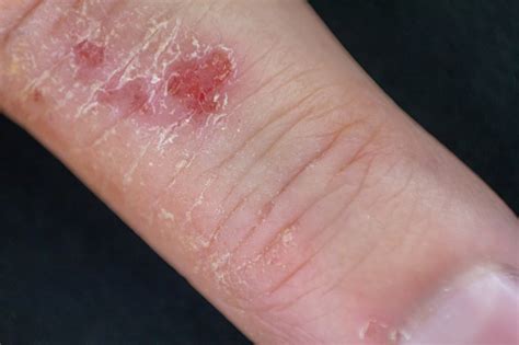 Foto De Dermatite Da Mão Eczema Do Dedo E Mais Fotos De Stock De