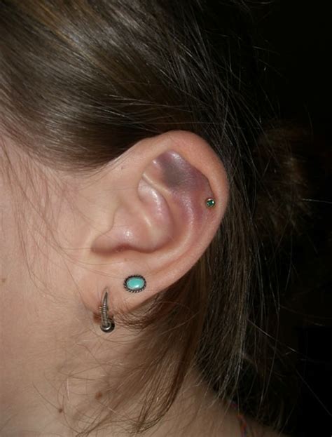 Infected Cartilage Piercings Causes Symptoms And Treatment