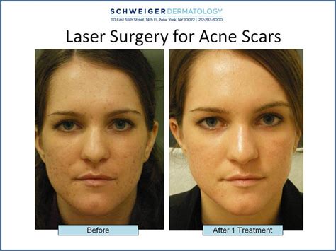 Fractional Co2 Laser For Acne Scars Clear Clinic