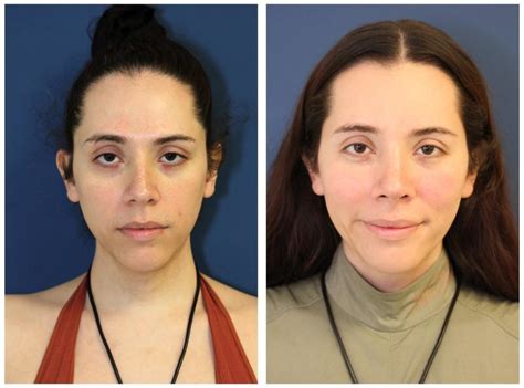 Nyc Facial Feminization Before And After Pictures Upper East Side